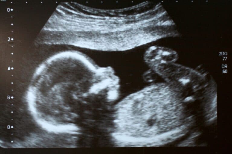 Ultraschallbild von Baby, auf dem man das Geschlecht erkennt