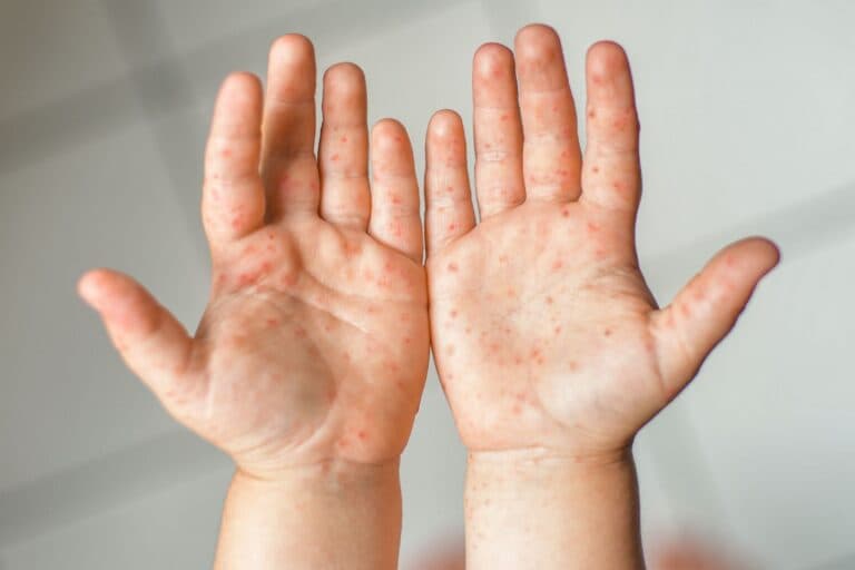 Kinderhände mit Ausschlag von Hand-Fuss-Mund-Krankheit
