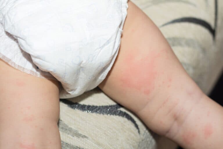 Kind in Windeln mit Windeldermatitis